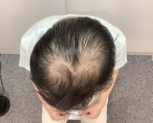 AGA治療前　43歳男性　生え際・頭頂部薄毛　新潟院