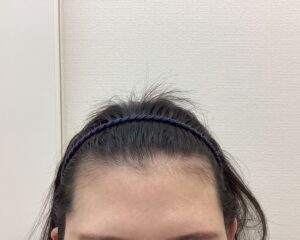 AGA治療前　24歳女性　生え際・分け目薄毛　新潟院