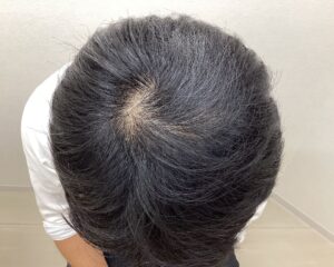 AGA治療3ヵ月目　43歳男性　頭頂部薄毛　横浜院