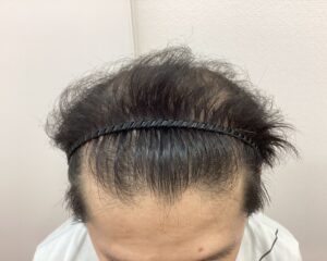 AGA治療前　43歳男性　生え際・頭頂部薄毛　新潟院