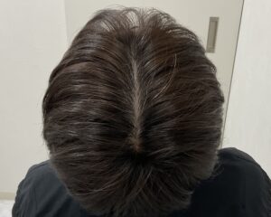  AGA治療10ヵ月後　38歳男性　生え際・頭頂部薄毛改善　岡山院