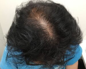 AGA治療前＿56歳男性＿生え際と頭頂部の薄毛＿大阪梅田院
