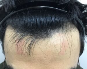 AGA治療後_33歳男性_生え際の改善_大阪梅田院