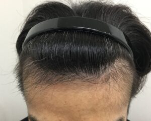 AGA治療後＿41歳男性＿生え際・頭頂部改善＿大阪梅田院