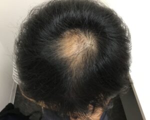 AGA治療後＿41歳男性＿生え際・頭頂部の改善＿大阪梅田院