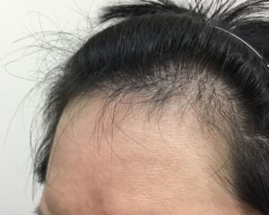 AGA治療後＿35歳男性＿生え際の改善＿大阪梅田院