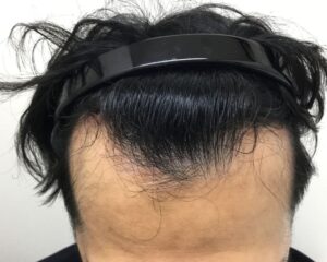 AGA治療後＿32歳男性＿生え際と頭頂部の改善＿大阪梅田院