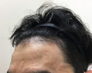 AGA治療後＿35歳男性＿生え際と頭頂部の改善＿大阪梅田院