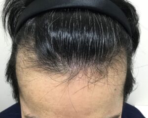 AGA治療後_56歳男性_生え際と頭頂部の改善_大阪梅田院