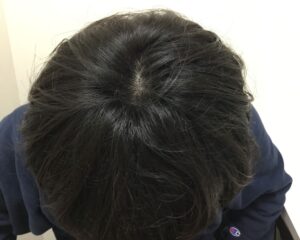AGA治療後＿27歳男性＿頭頂部の改善＿大阪梅田院