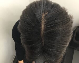 AGA治療後_41歳男性_生え際と頭頂部の改善_大阪梅田院
