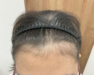FAGA治療後＿23歳女性＿生え際・頭頂部改善＿広島院