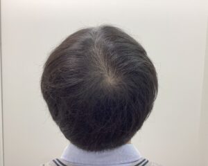 AGA治療前　36歳男性　前頭・頭頂部薄毛　新潟院