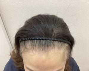 FAGA治療前　49歳女性　生え際・分け目薄毛　新潟院