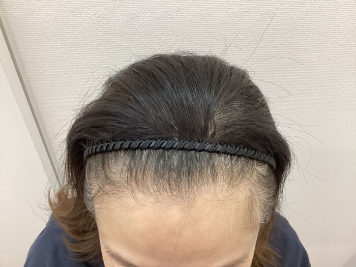 【49歳女性】生え際・分け目の薄毛がFAGA治療で改善中｜新潟院
