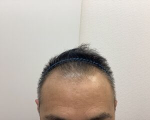 AGA治療前　49歳男性　生え際・頭頂部薄毛　新潟院