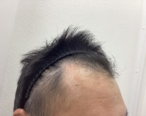 AGA治療9ヶ月後　47歳男性　生え際・頭頂部改善　新潟院