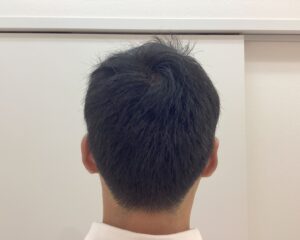 AGA治療1年6ヶ月後　47歳男性　生え際・頭頂部改善　新潟院