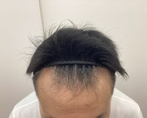 AGA治療1年6ヶ月後　47歳男性　生え際・頭頂部改善　新潟院