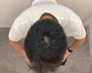 AGA治療1年6ヶ月後　47歳男性　生え際・頭頂部改善　新潟院