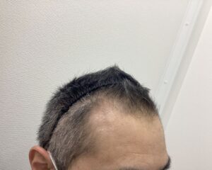 AGA治療3ヶ月後　49歳男性　生え際・頭頂部改善中　新潟院