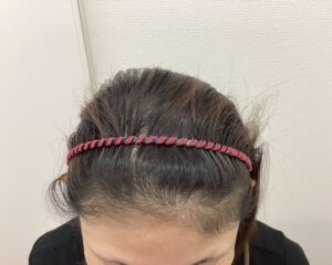 FAGA9ヶ月後　40歳女性　生え際・頭頂部改善中　新潟院