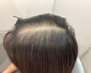 FAGA9ヶ月後　40歳女性　生え際・頭頂部改善中　新潟院