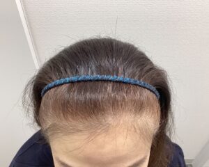 FAGA5ヶ月後　49歳女性　生え際・分け目改善中　新潟院