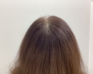 FAGA5ヶ月後　49歳女性　生え際・分け目改善中　新潟院