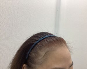 FAGA5ヶ月後　49歳女性　生え際・分け目改善中　新潟院
