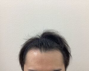 AGA治療5ヶ月後　36歳男性　前頭・頭頂部改善中　新潟院