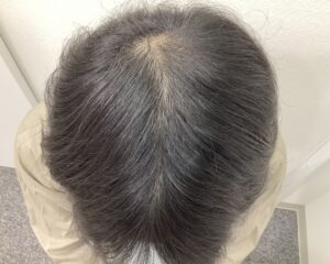 AGA治療5ヶ月後　36歳男性　前頭・頭頂部改善中　新潟院