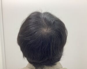 AGA治療5ヶ月後　36歳男性　前頭・頭頂部改善中　新潟院