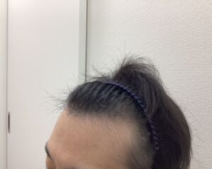 AGA治療5ヶ月後　36歳男性　前頭・頭頂部改善中　新潟院