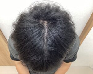 AGA治療12ヵ月経過　23歳男性　頭頂部　横浜院