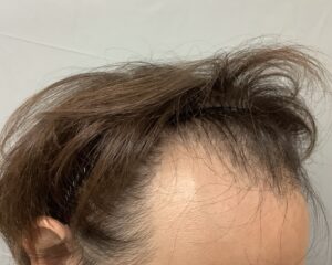 AGA治療前 34歳男性 生え際・頭頂部薄毛 金沢院