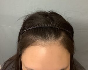 AGA治療前　22歳女性　生え際・ボリューム　金沢院