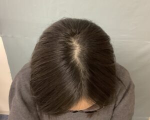 AGA治療前　22歳女性　生え際・ボリューム　金沢院