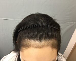 AGA治療後　22歳女性　生え際・ボリューム　金沢院