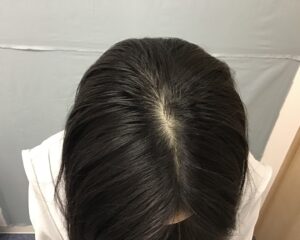 AGA治療後　22歳女性　生え際・ボリューム　金沢院