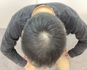 AGA治療前　47歳男性　生え際・頭頂部薄毛　新潟院