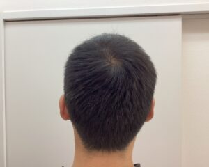 AGA治療前　47歳男性　生え際・頭頂部薄毛　新潟院
