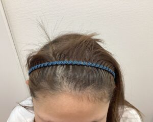 FAGA治療前　40歳女性　生え際・頭頂部薄毛　新潟院