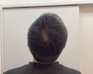 AGA治療前　47歳男性　生え際・頭頂部薄毛　新潟院