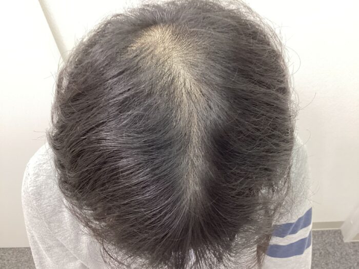 【36歳男性】前頭・頭頂部の薄毛がAGA治療で改善中｜新潟院