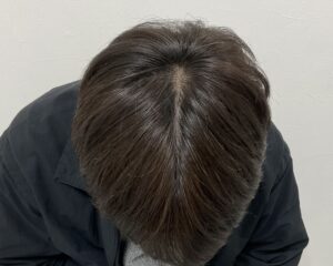  AGA治療10ヵ月後　38歳男性　生え際・頭頂部薄毛改善　岡山院
