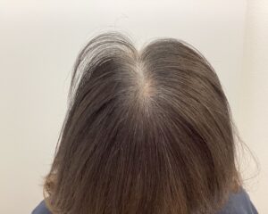 FAGA治療前　49歳女性　生え際・分け目薄毛　新潟院