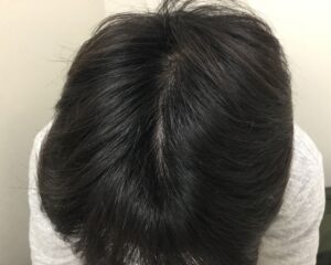 AGA治療後＿31歳男性＿頭頂部・生え際の改善＿大阪梅田院