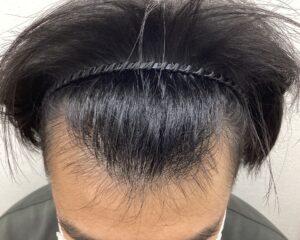 AGA治療12ヵ月経過　23歳男性　生え際　横浜院