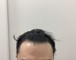 AGA治療前　36歳男性　前頭・頭頂部薄毛　新潟院